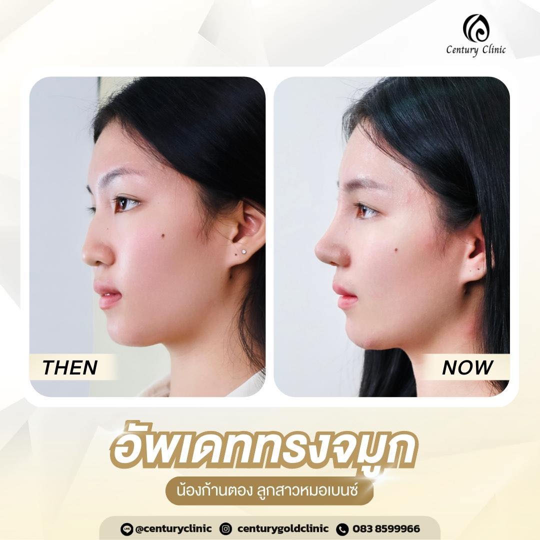 Century-รีวิว-เสริมจมูก #688