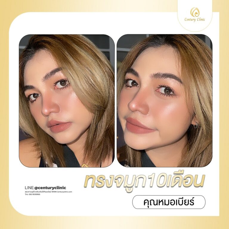 Century-รีวิว-เสริมจมูก #691