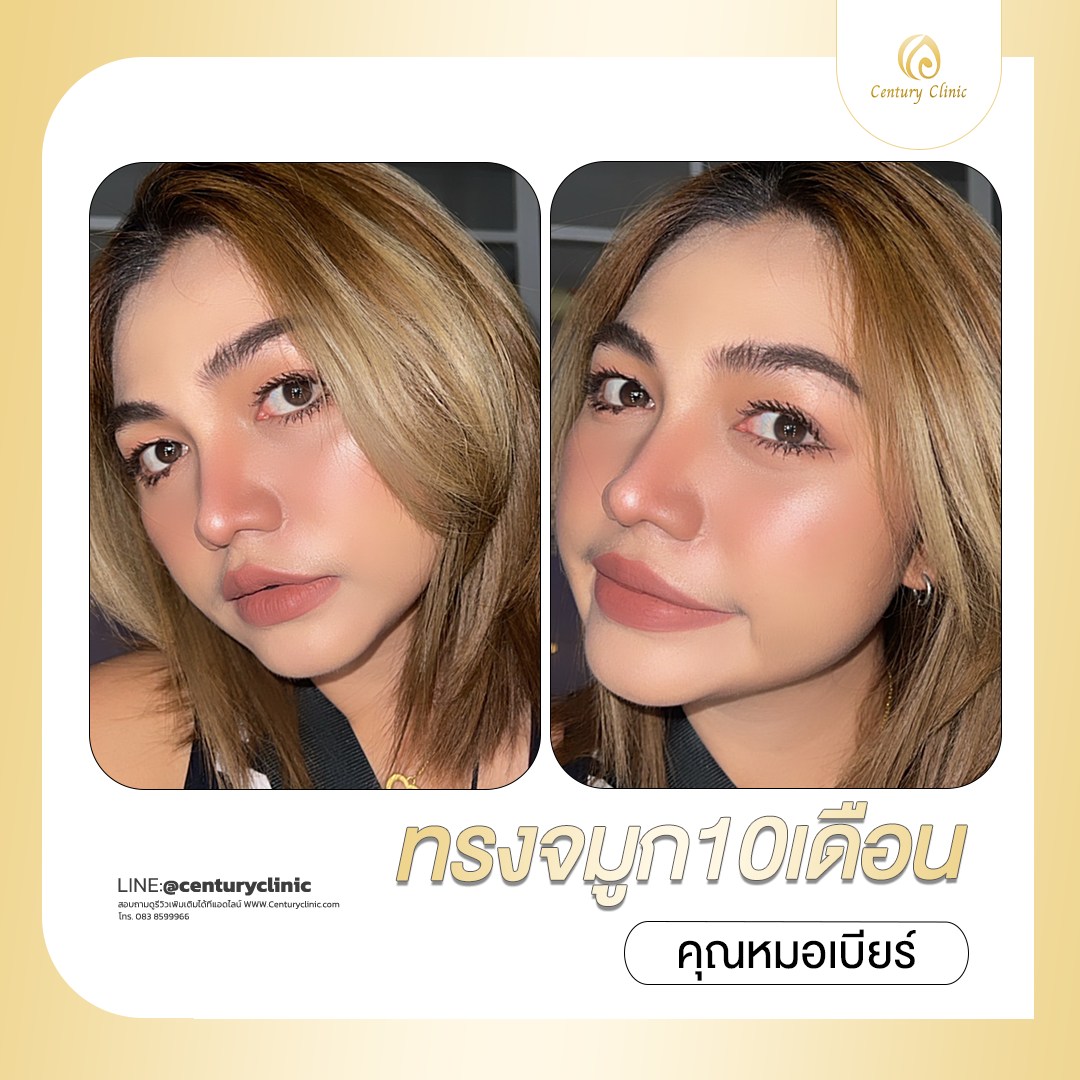 Century-รีวิว-เสริมจมูก #691