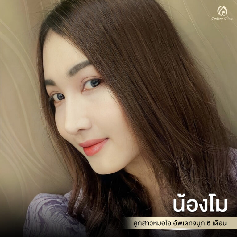 Century-รีวิว-เสริมจมูก #693