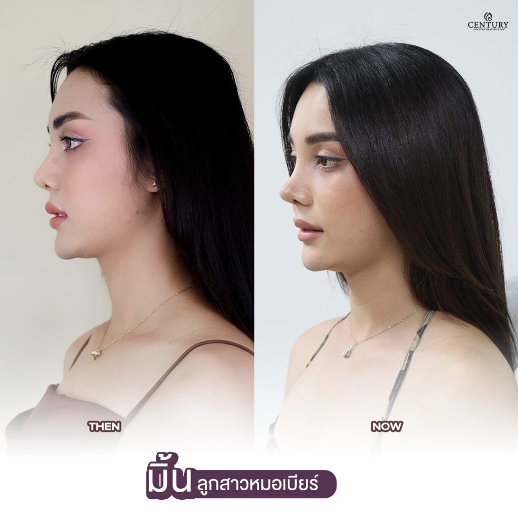 Century-รีวิว-เสริมจมูก2 #664