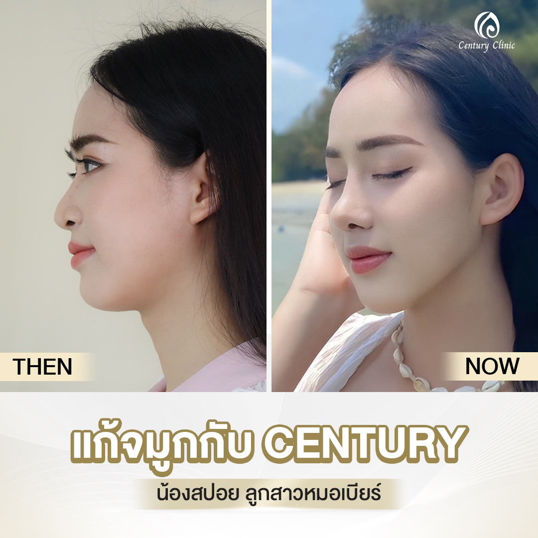 Century-รีวิว-แก้จมูก #689
