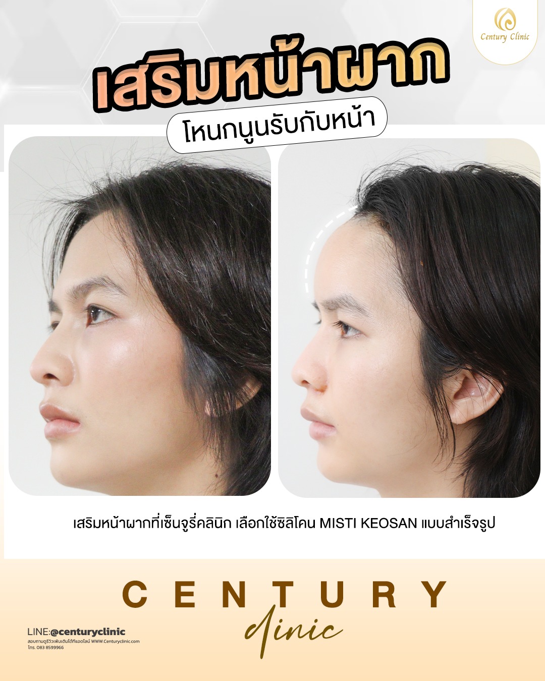 Review เสริมหน้าผาก #26
