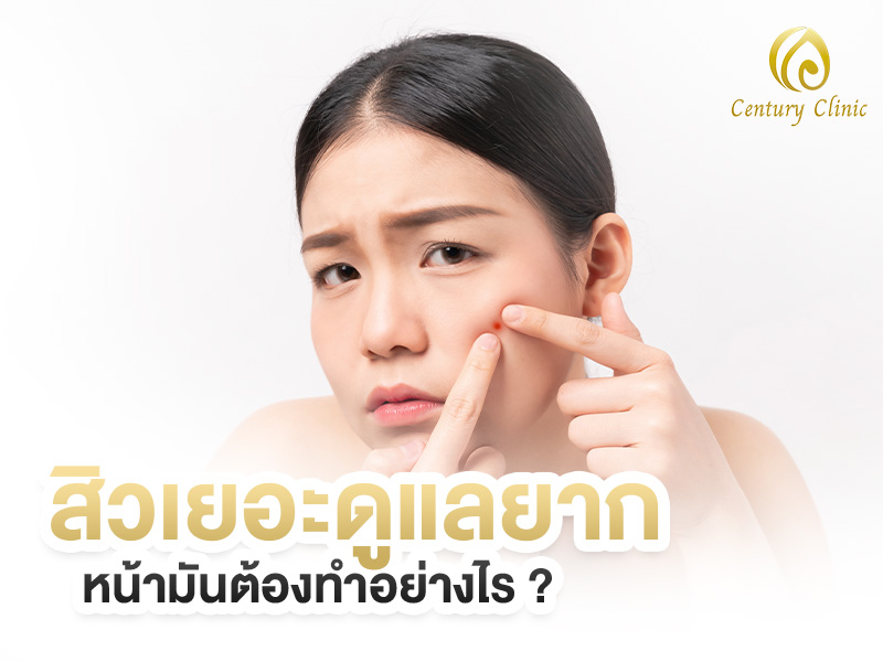 สิวเยอะ ดูแลยากน่ามัน ต้องทำอย่างไร