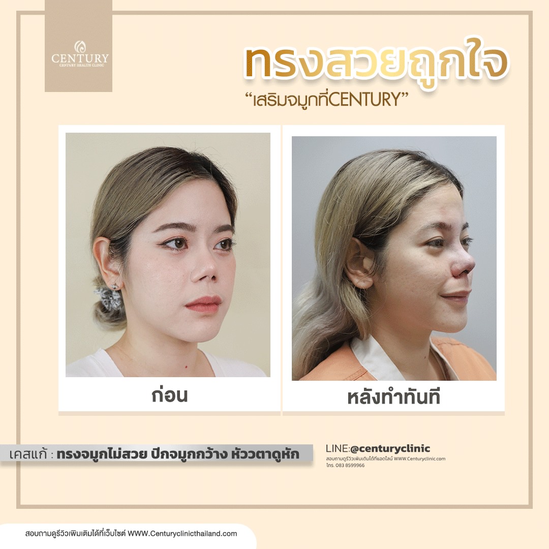 Century-รีวิว-เสริมจมูก #700