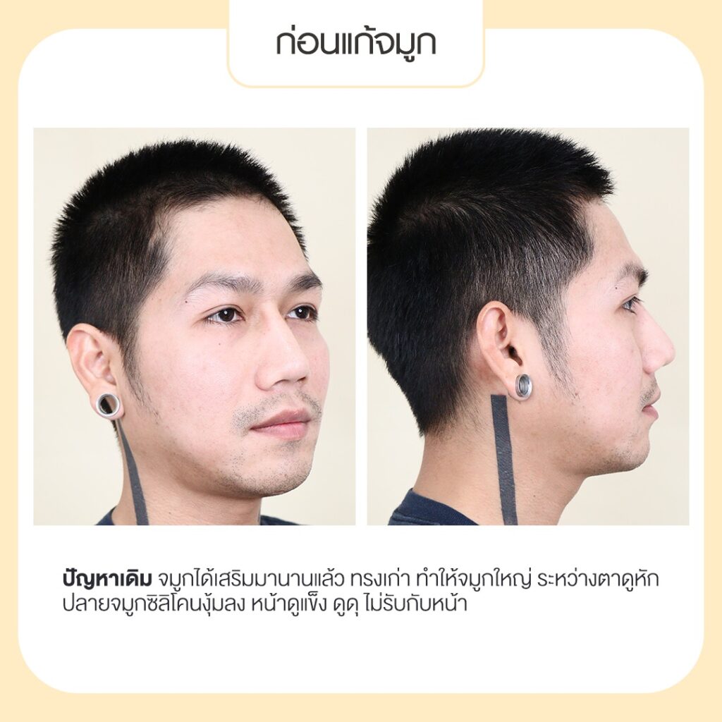 Century-รีวิว-แก้จมูก 1#717