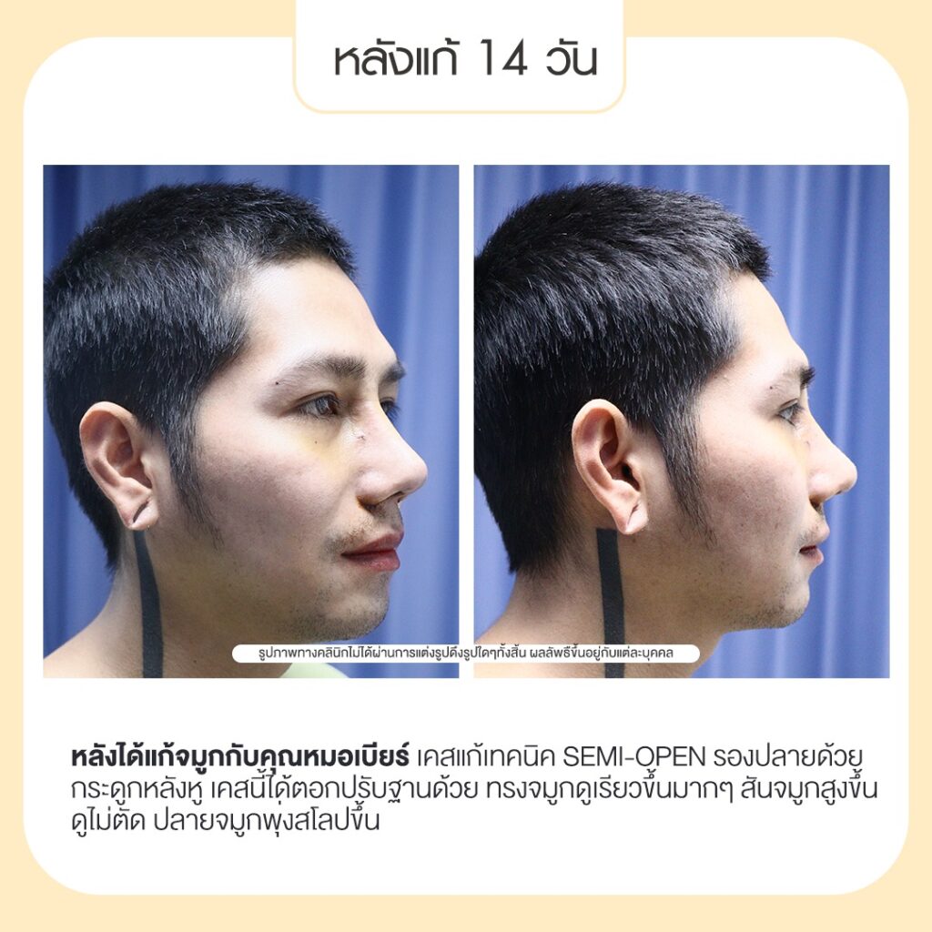 Century-รีวิว-แก้จมูก 2#717