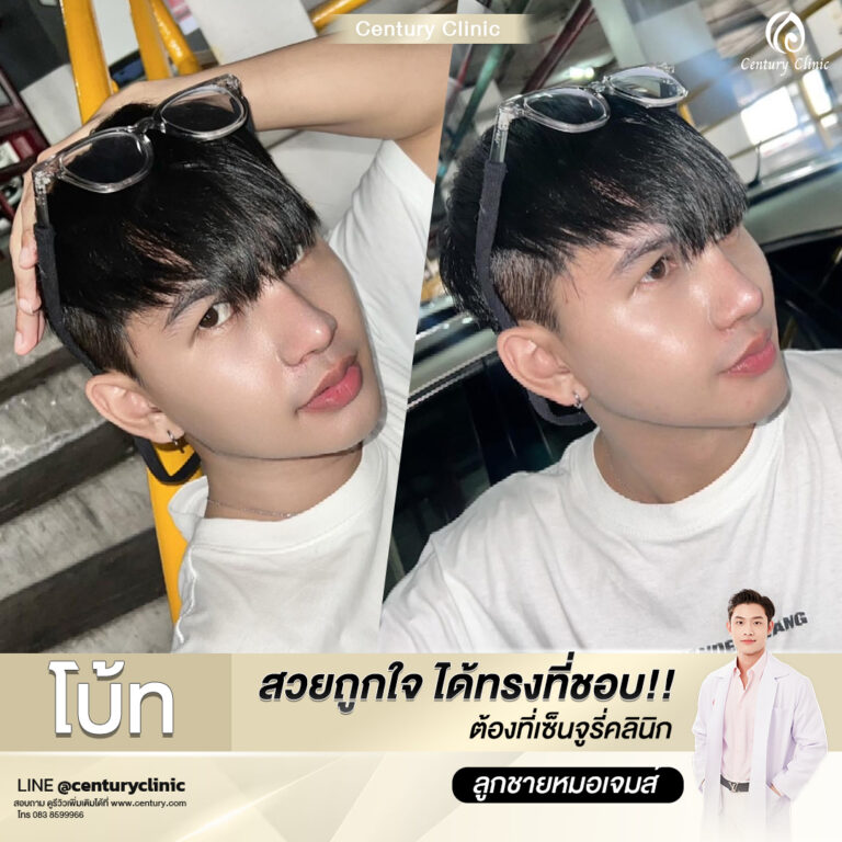 Century-รีวิว-เสริมจมูก #726