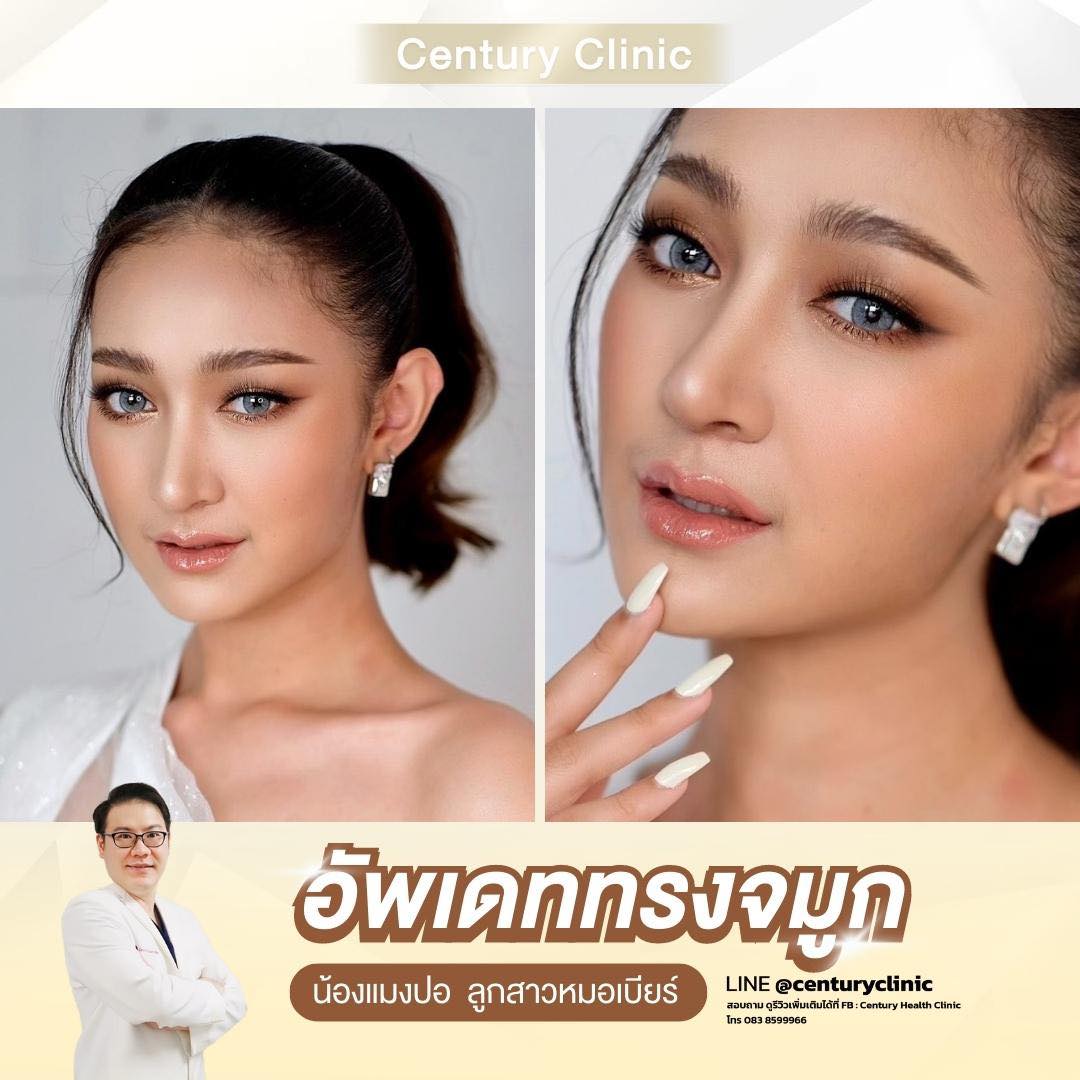 Century-รีวิว-เสริมจมูก #732