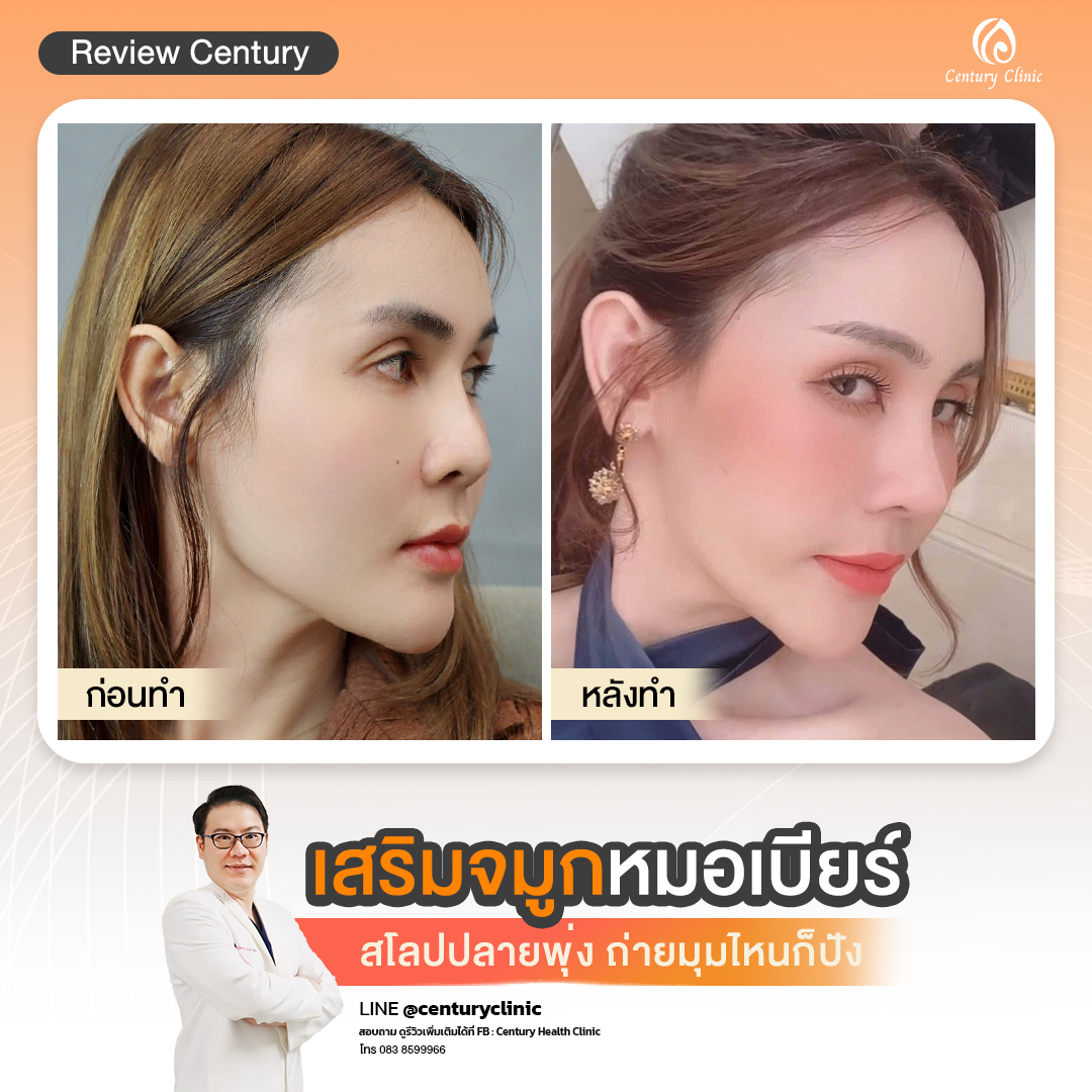 Century-รีวิว-เสริมจมูก #746
