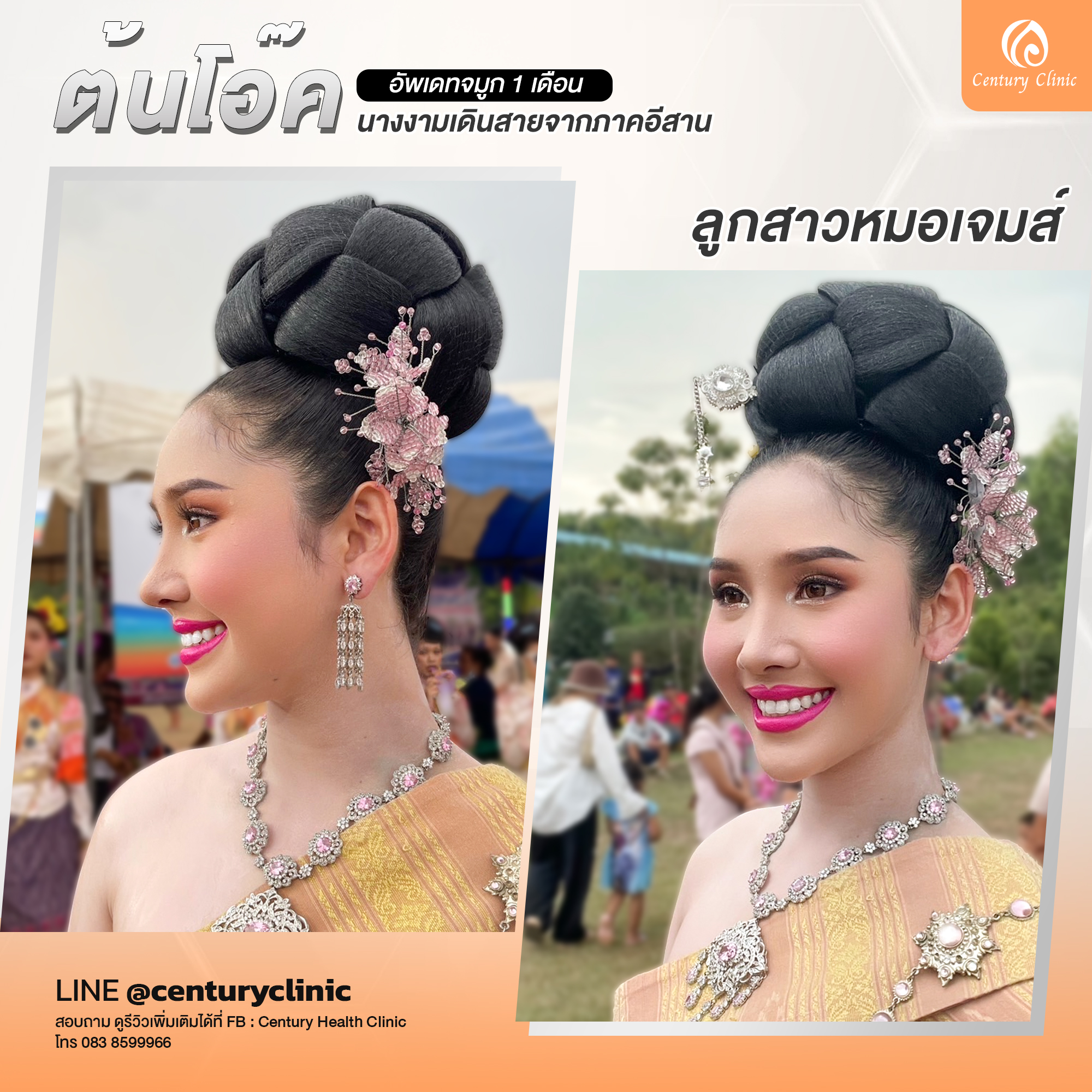 Century-รีวิว-เสริมจมูก #754