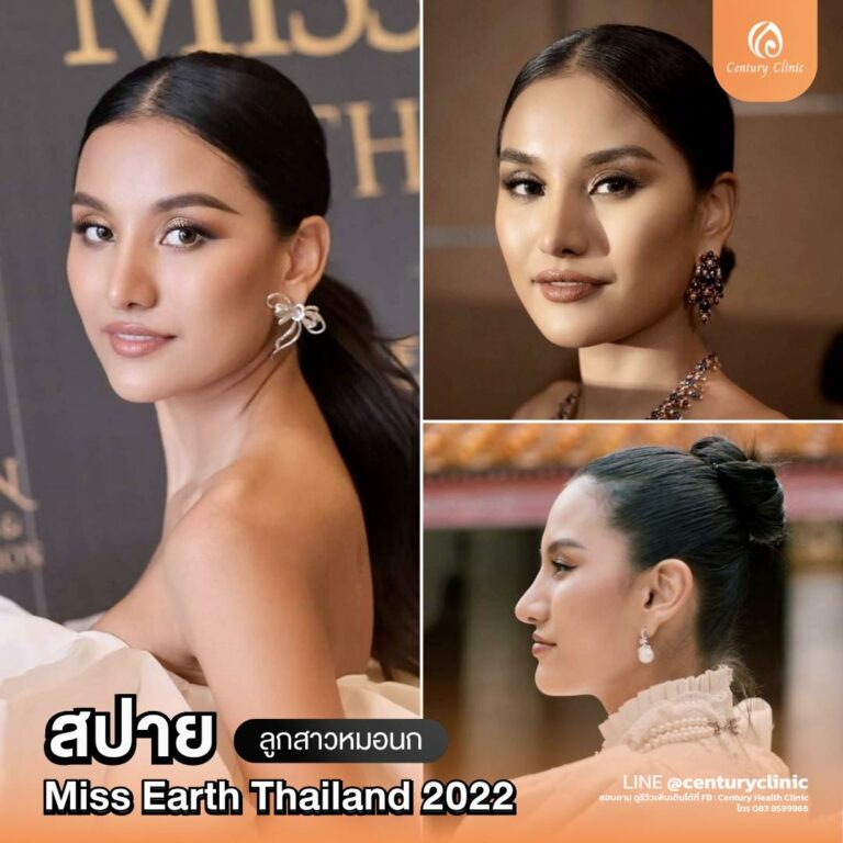 Century-รีวิว-เสริมจมูก #759