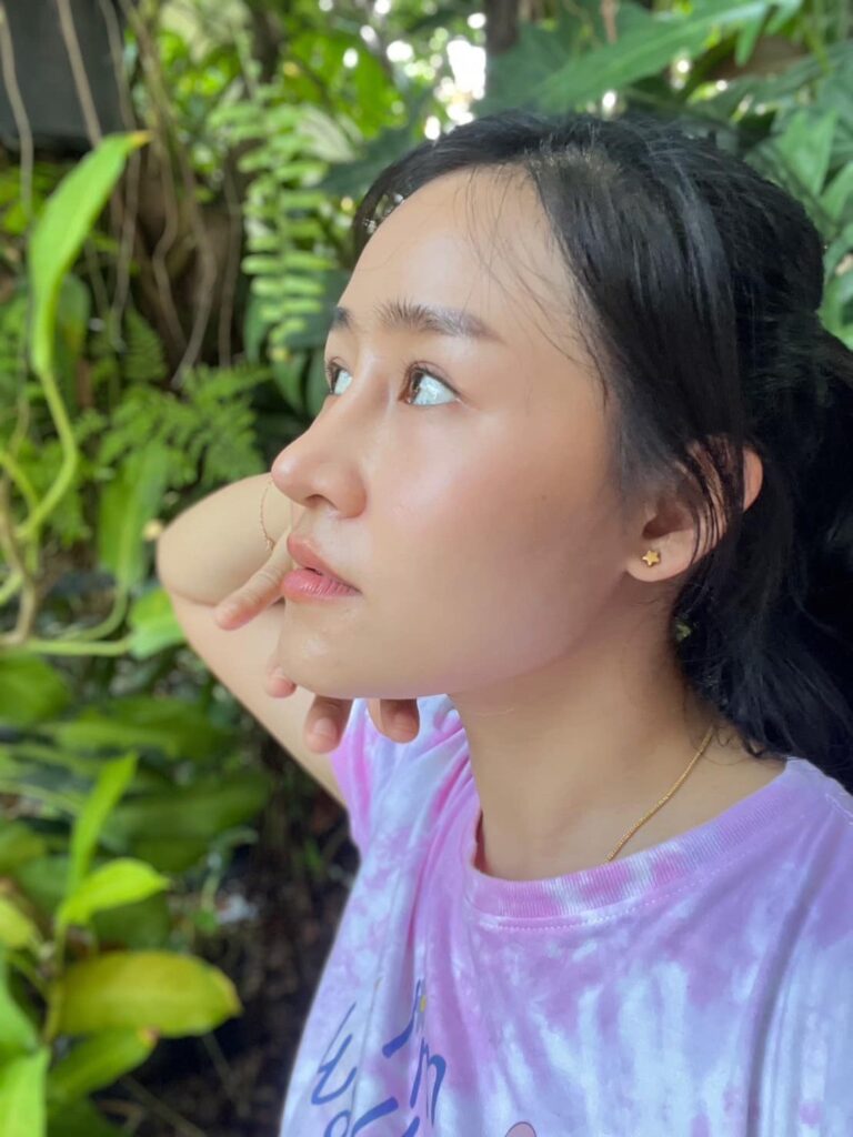 รีวิว แก้จมูก #737 , Century Clinic Thailand Century-รีวิว-แก้จมูก 1#737