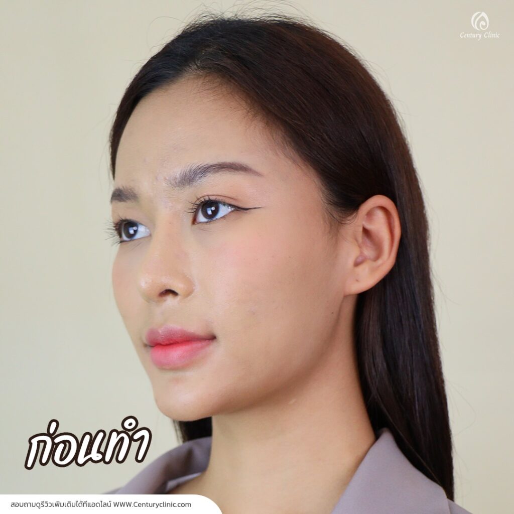 Century-รีวิว-แก้จมูก 1#739