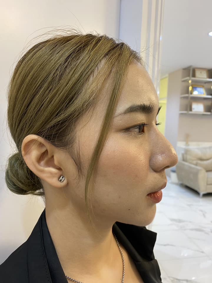 รีวิว แก้จมูก #750 , Century Clinic Thailand Century-รีวิว-แก้จมูก 2#750