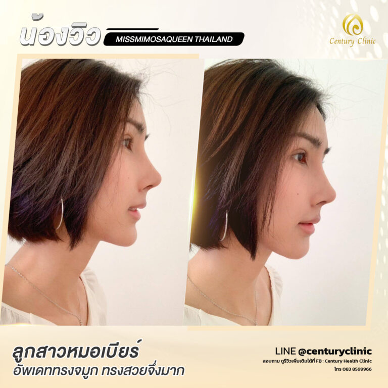 Century-รีวิว-แก้จมูก #724