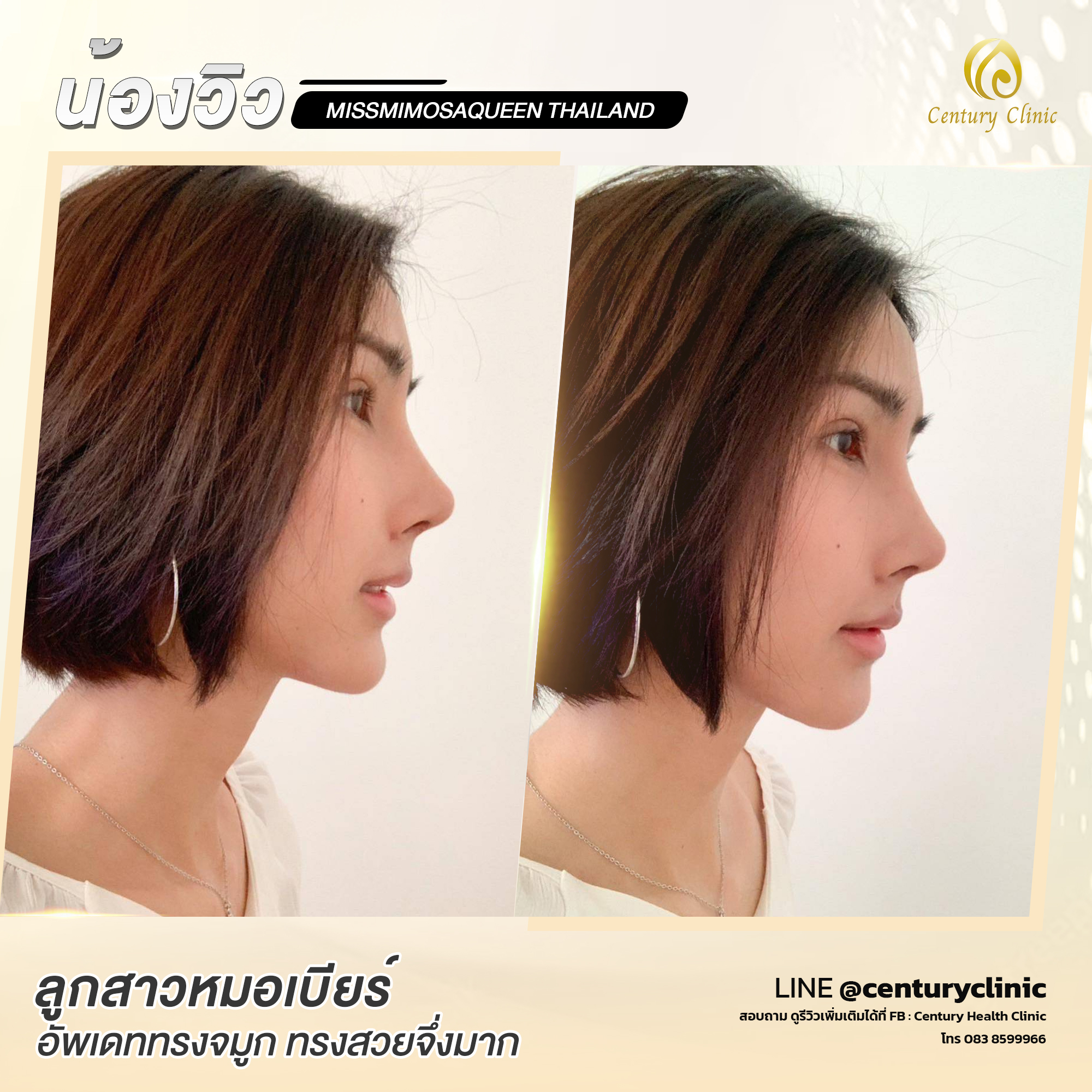 Century-รีวิว-แก้จมูก #724