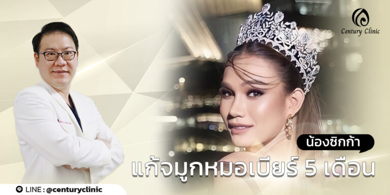 Century-รีวิว-แก้จมูก #725