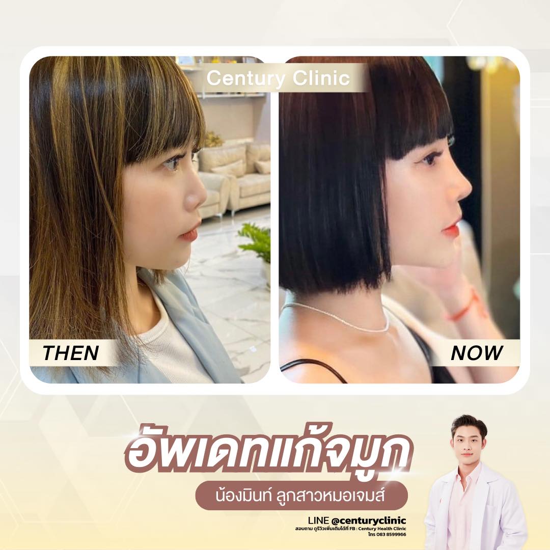 Century-รีวิว-แก้จมูก #736
