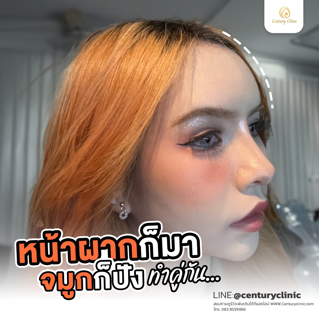 รีวิว แก้จมูก #743 , Century Clinic Thailand Century-รีวิว-แก้จมูก #743