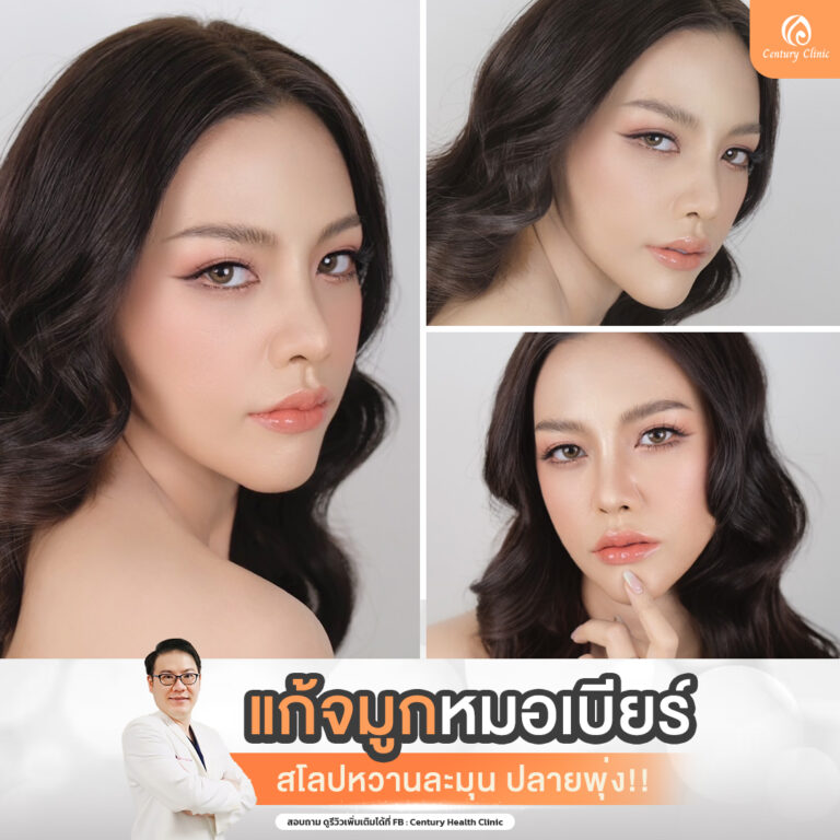 Century-รีวิว-แก้จมูก #752