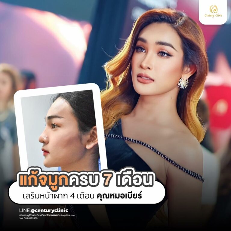 Century-รีวิว-แก้จมูก #755