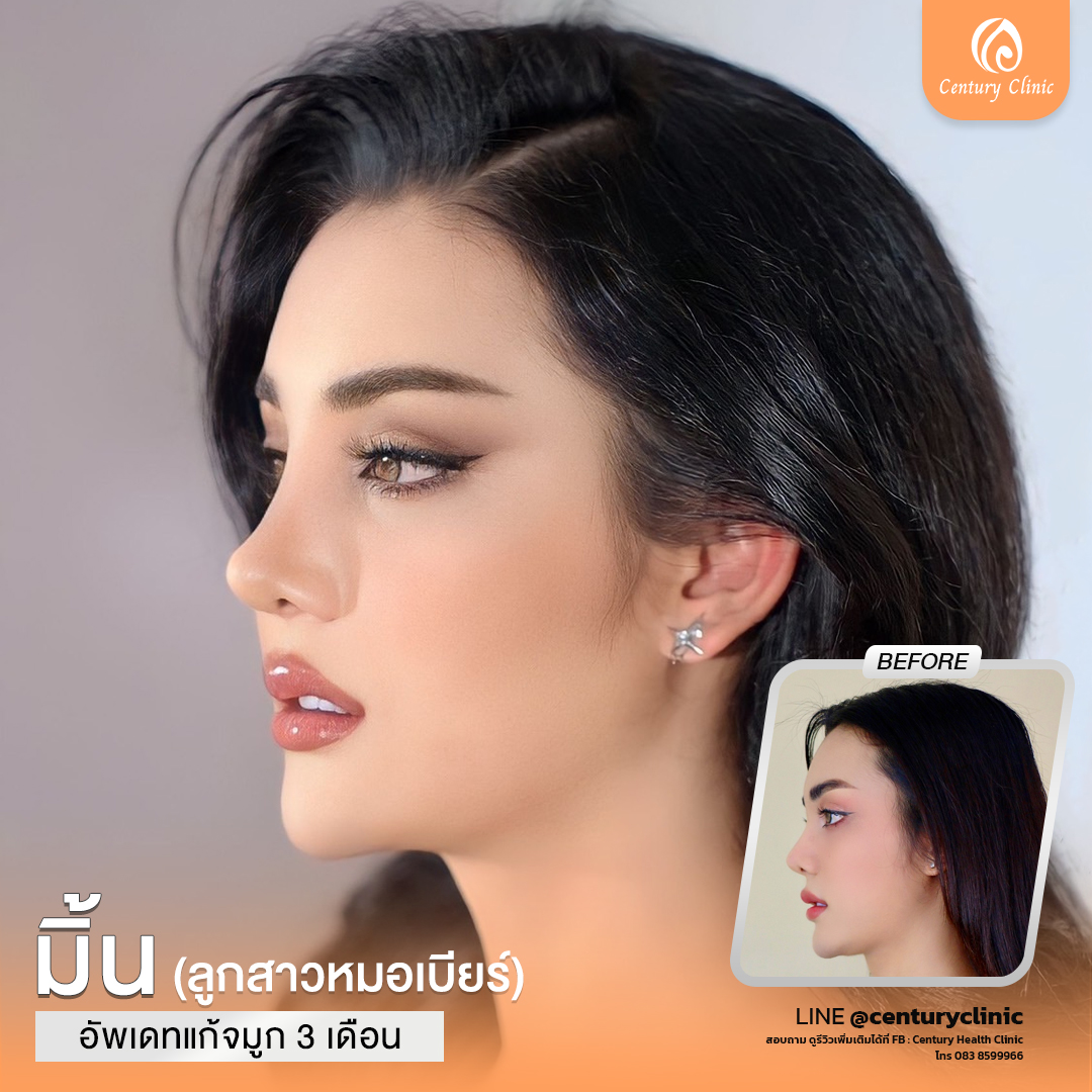 Century-รีวิว-แก้จมูก #763