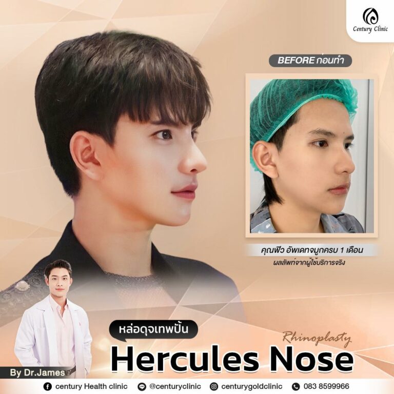 Century-รีวิว-เสริมจมูก #773