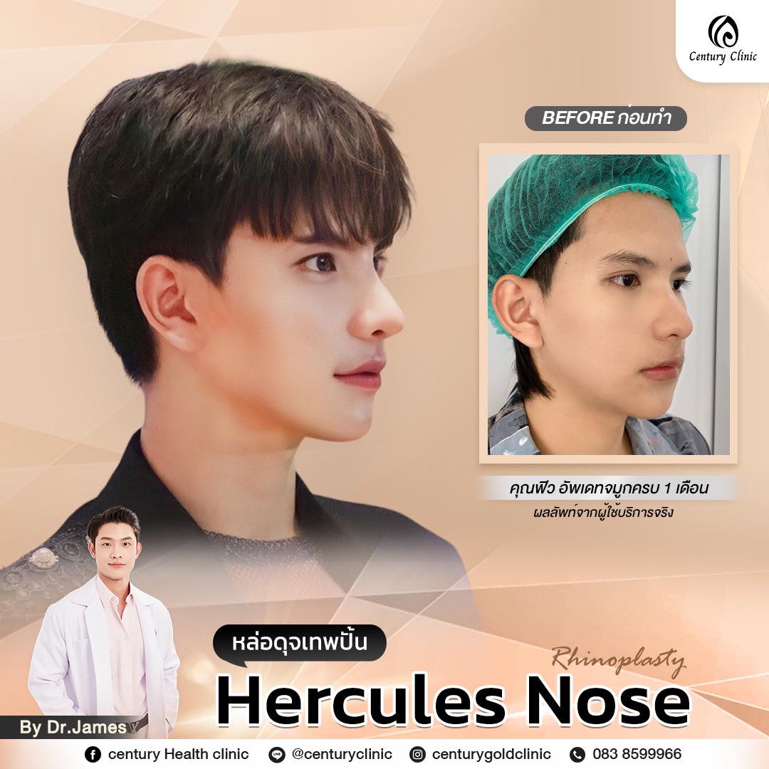 Century-รีวิว-เสริมจมูก #773