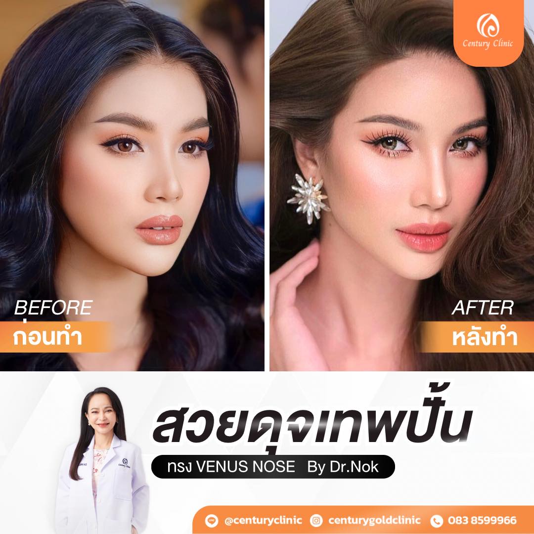 รีวิว แก้จมูก #767 , Century Clinic Thailand Century-รีวิว-แก้จมูก #767