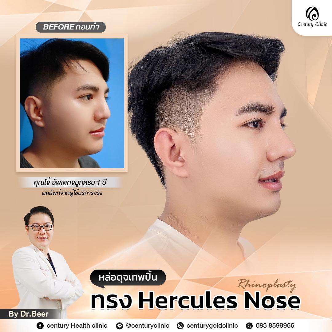 Century-รีวิว-แก้จมูก #771