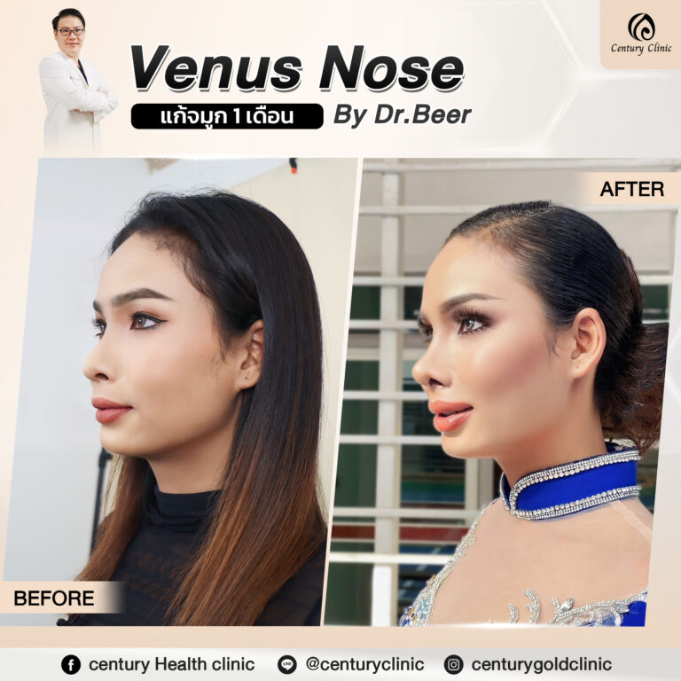 Century-รีวิว-แก้จมูก #777