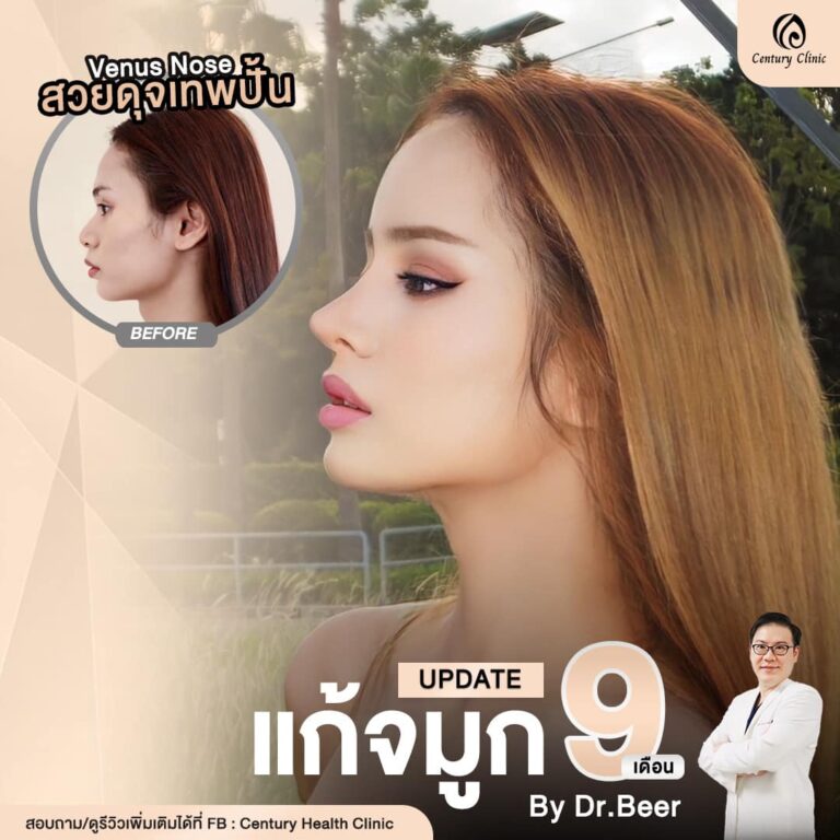 Century-รีวิว-แก้จมูก #780