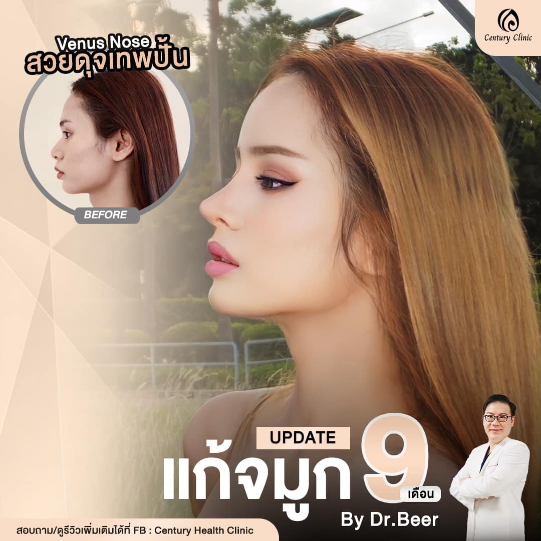 Century-รีวิว-แก้จมูก #780