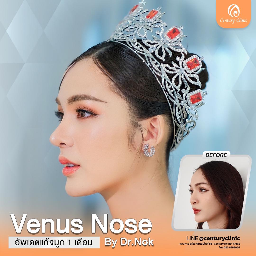 รีวิว แก้จมูก #781 , Century Clinic Thailand Century-รีวิว-แก้จมูก #781
