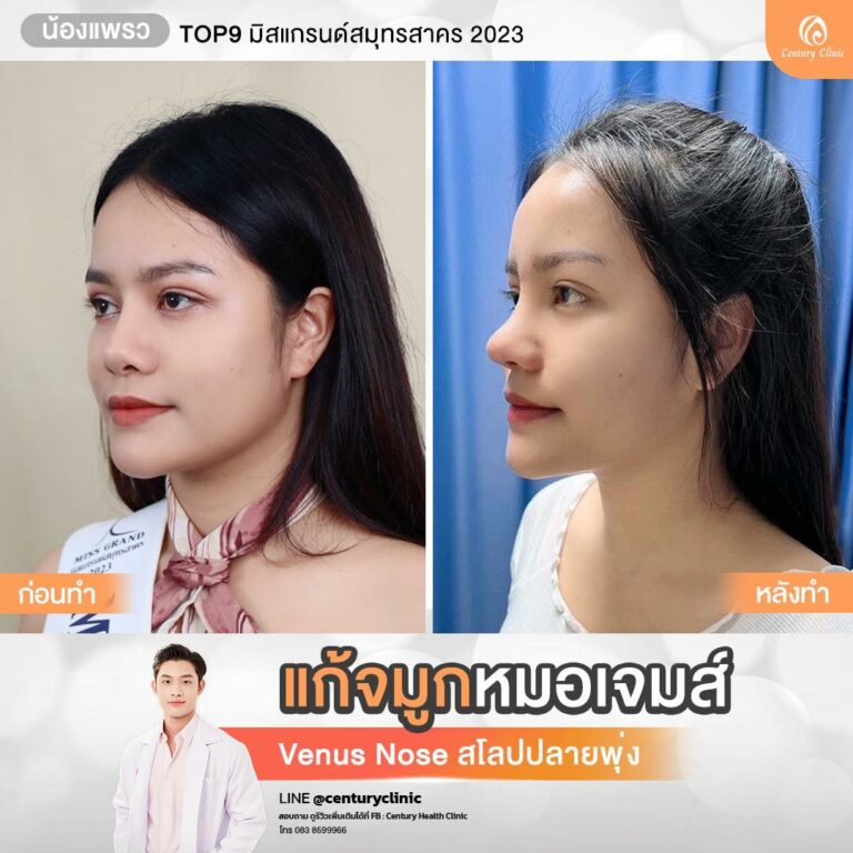 Century-รีวิว-แก้จมูก #782