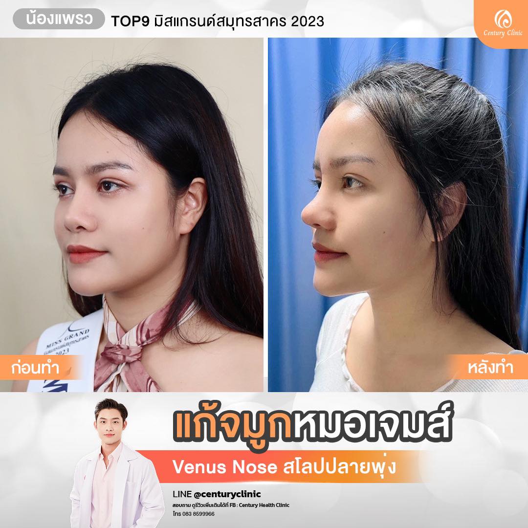 Century-รีวิว-แก้จมูก #782