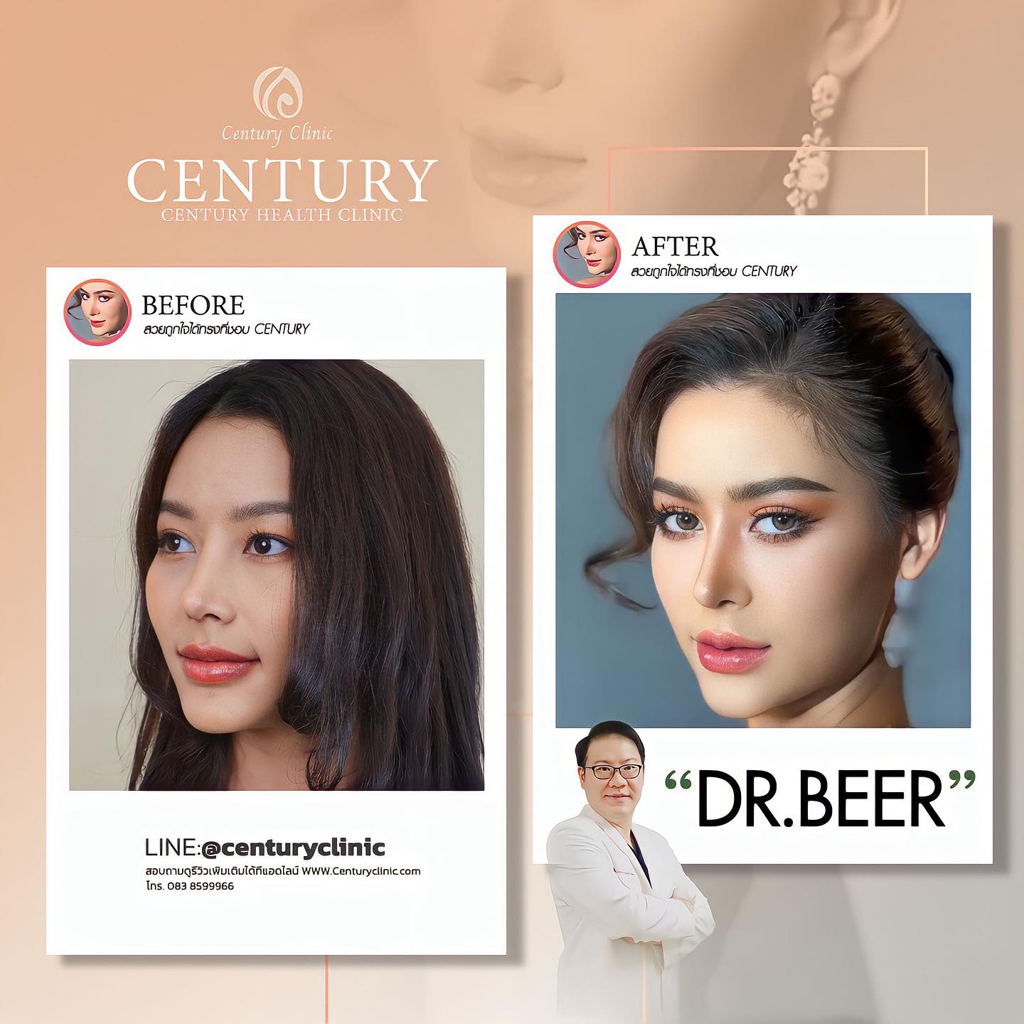 Century-เสริมจมูก #770