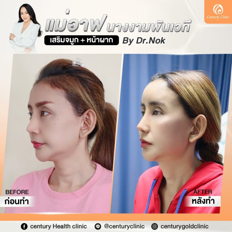 Century-เสริมจมูก หน้าผาก #768