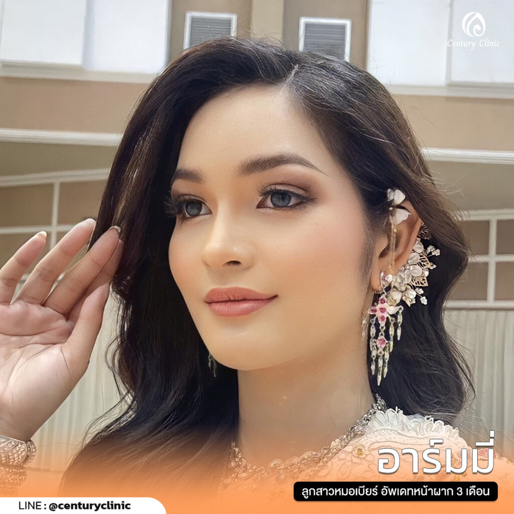 รีวิว เสริมหน้าผาก #28 , Century Clinic Thailand Review เสริมหน้าผาก 1#28