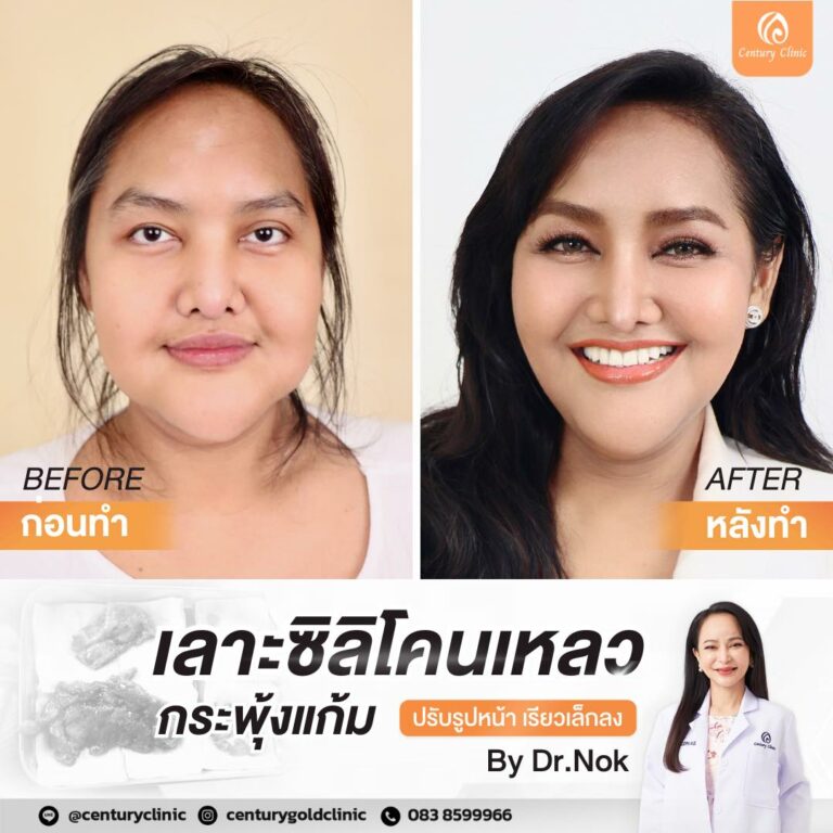 รีวิว ตัดไขมันกระพุ้งแก้ม #9