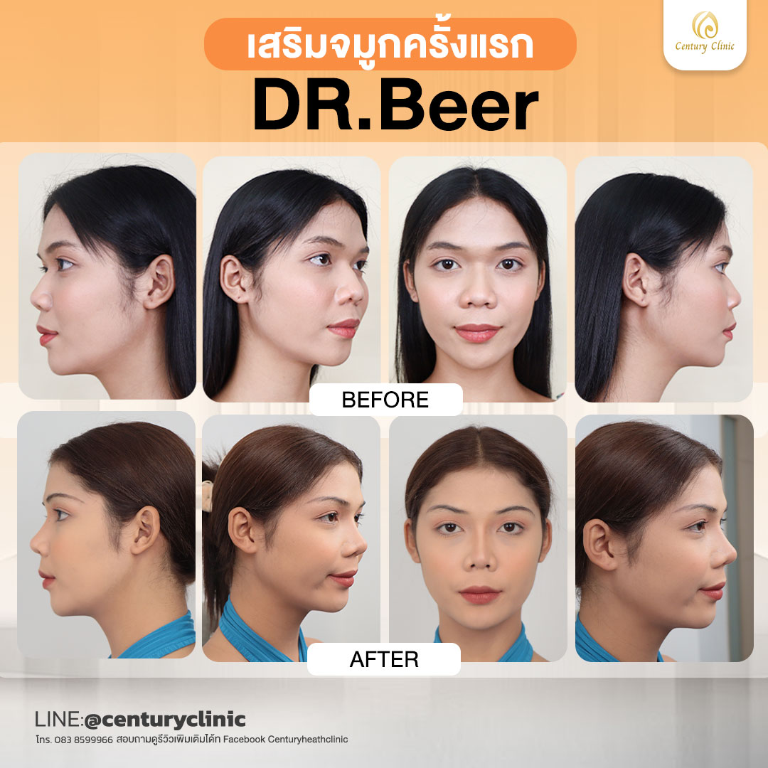 Century-รีวิว-เสริมจมูก #801