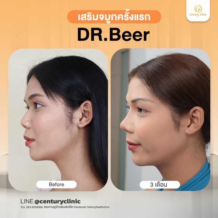Century-รีวิว-เสริมจมูก #814