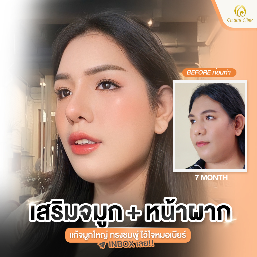 Century-รีวิว-เสริมจมูก #815
