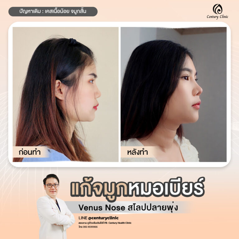 Century-รีวิว-เสริมจมูก #825