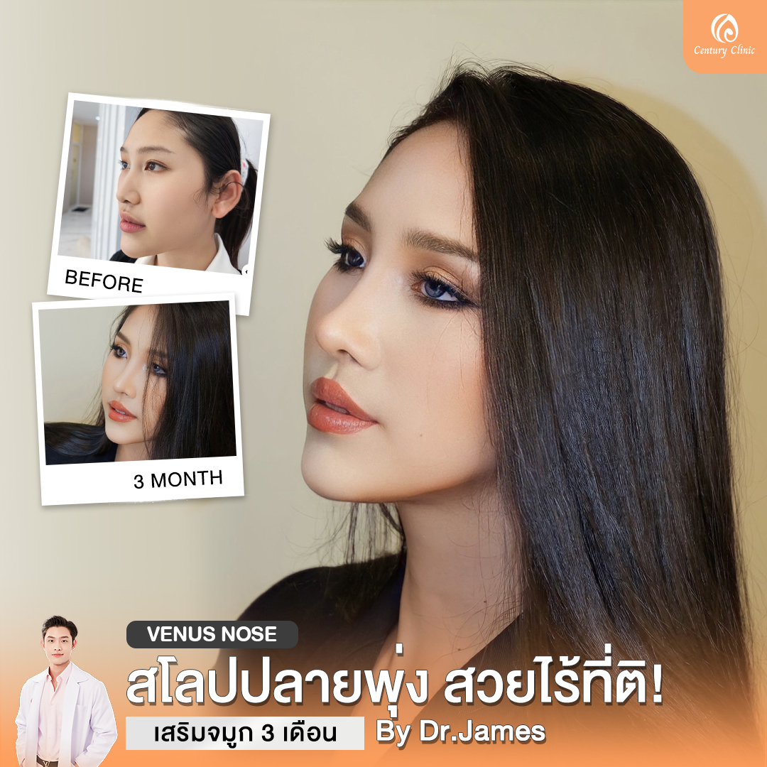 รีวิว เสริมจมูก #829 , Century Clinic Thailand Century-รีวิว-เสริมจมูก #829
