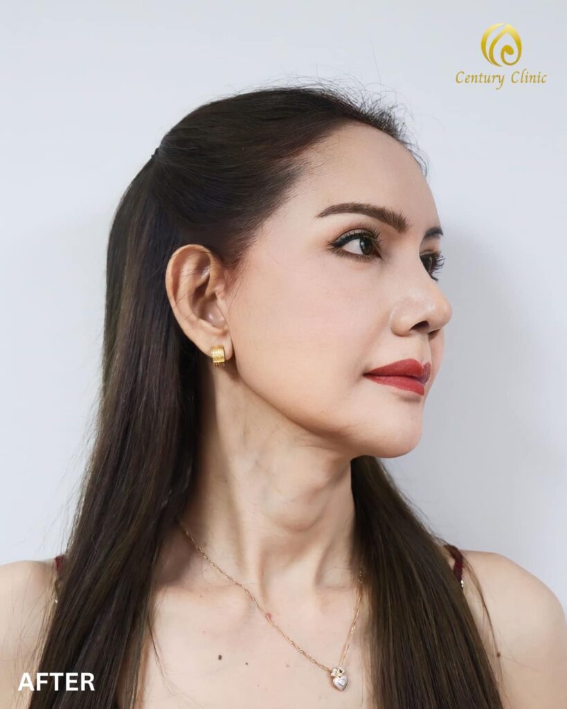 รีวิว แก้จมูก #787 , Century Clinic Thailand Century Clinic Thailand