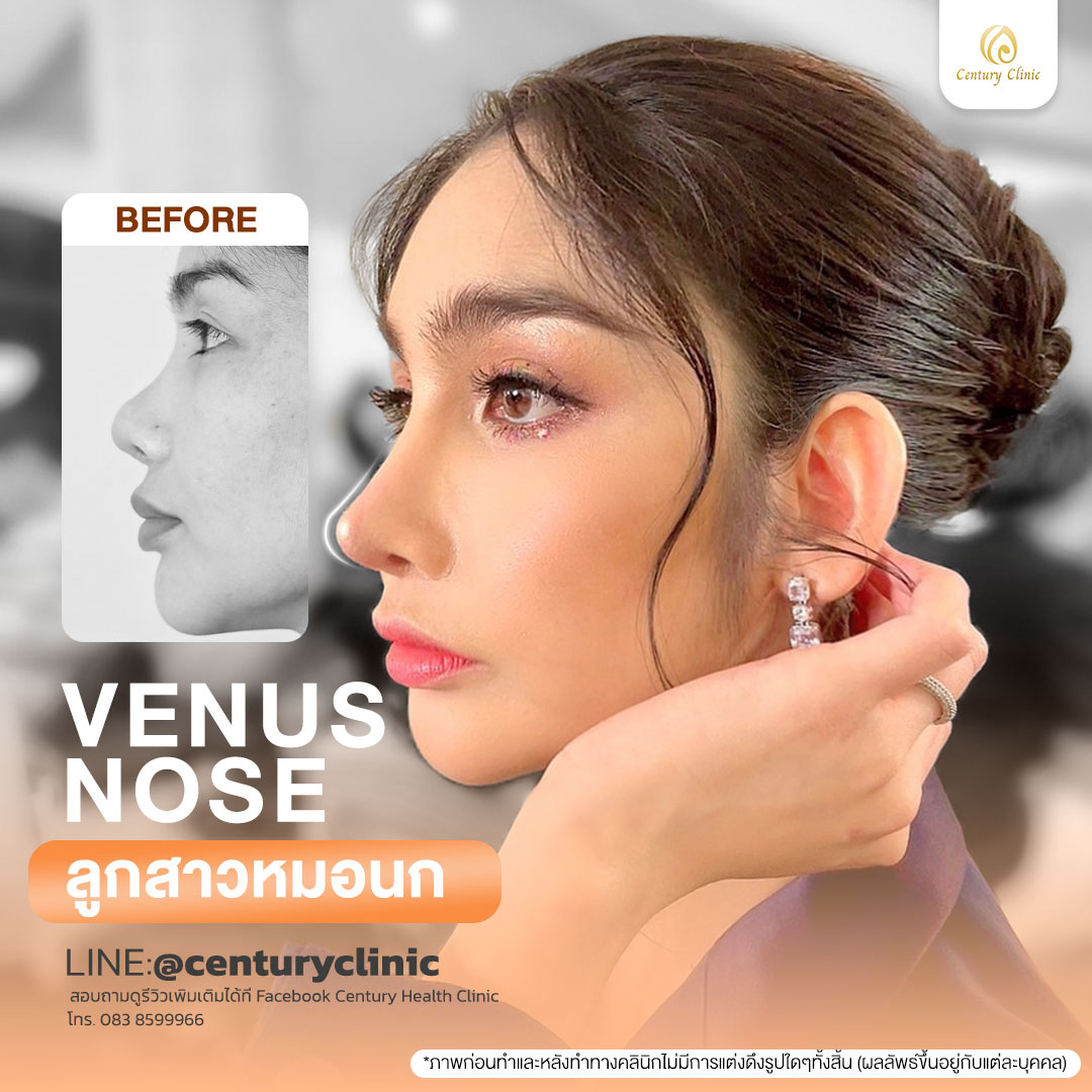 Century-รีวิว-แก้จมูก #800