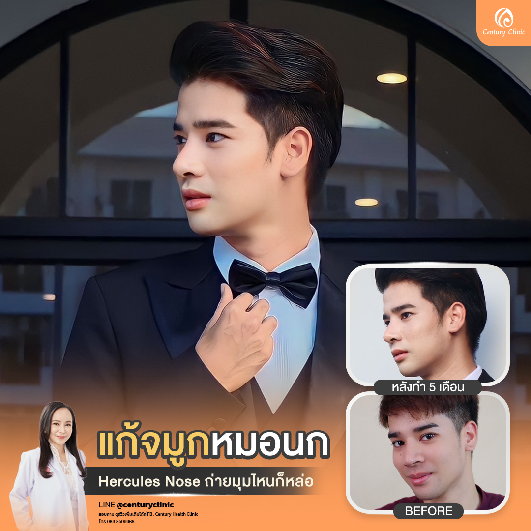 Century-รีวิว-แก้จมูก #810