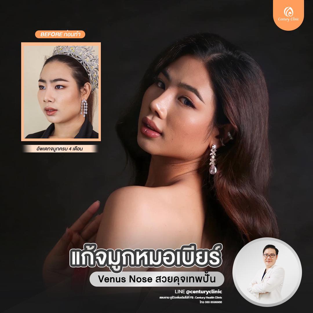 รีวิว แก้จมูก #820 , Century Clinic Thailand Century-รีวิว-แก้จมูก #820
